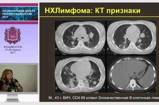 И.А. Соколина - Неинфекционная патология органов дыхания у ВИЧ-инфицированных
