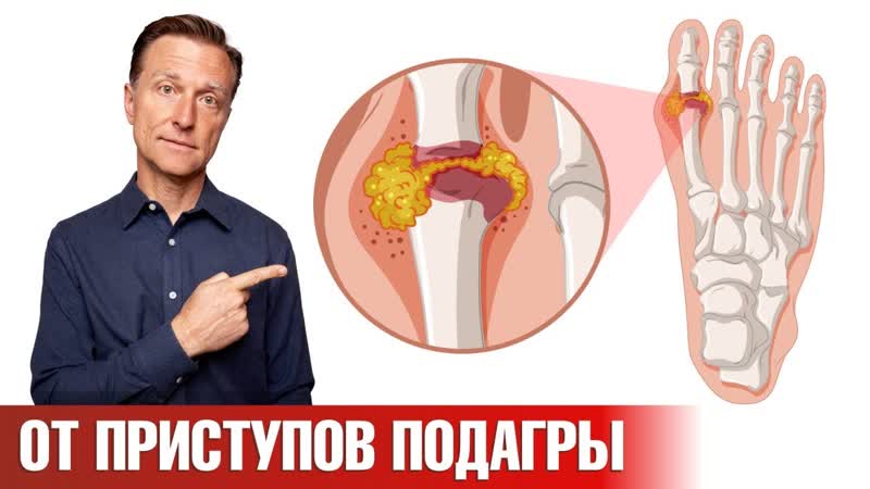 Средство 1 от приступов подагры, которое есть у
